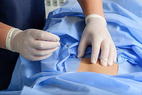 Epidural Injections