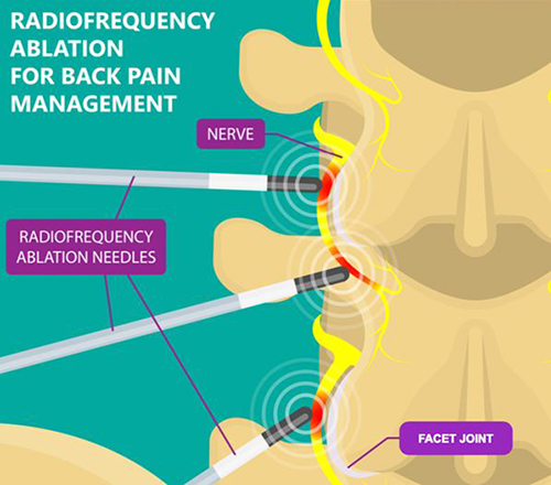 Radio frequency Ablation
