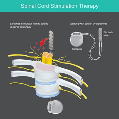 Spinal Cord Stimulator